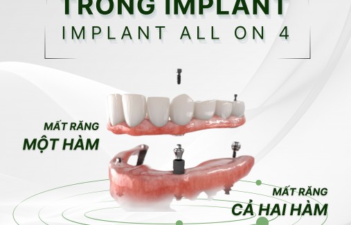 Trồng Răng Implant All On 4 Cho Người Mất Răng Toàn Hàm